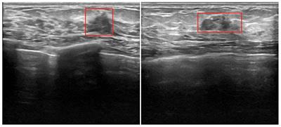 Deep learning-based immunohistochemical estimation of breast cancer via ultrasound image applications